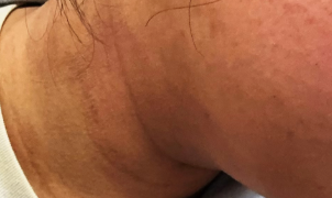 每天一杯奶茶，17岁孩子脖子越来越黑？医生提醒：这不是脏，是身体在报警